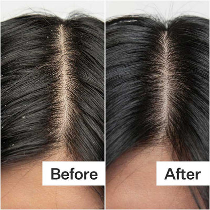 Dry + Itchy Scalp System by Act+Acre