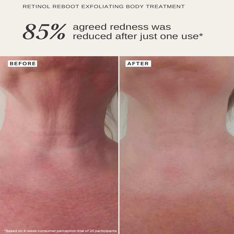 Retinol Reboot Exfoliating Body Treatment With 1% Encapsulated Retinol by Alpha-H