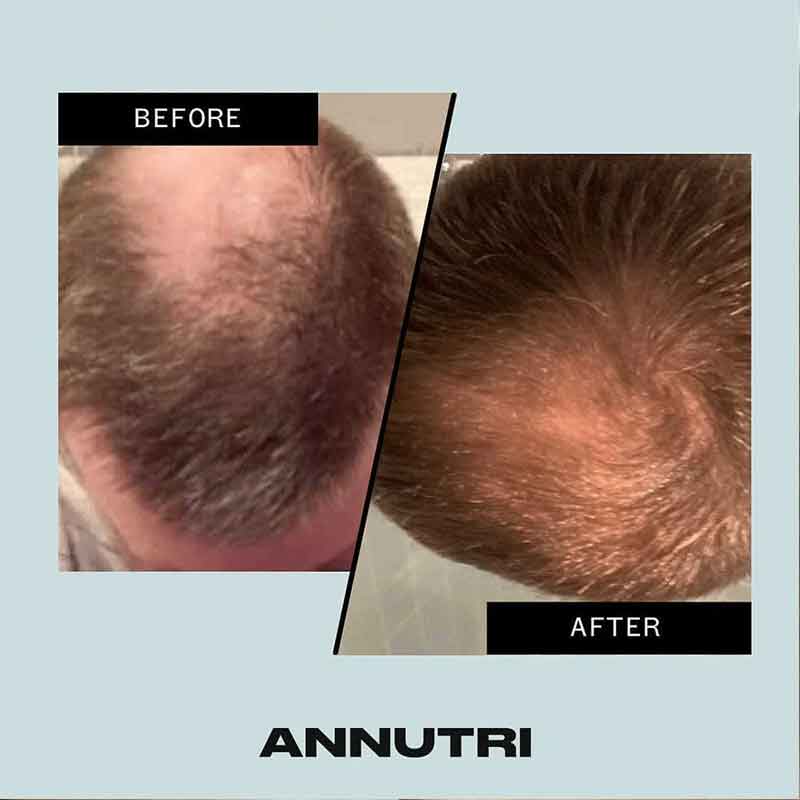 Grow It Hair Growth Supplement 6 Month Supply by Annutri