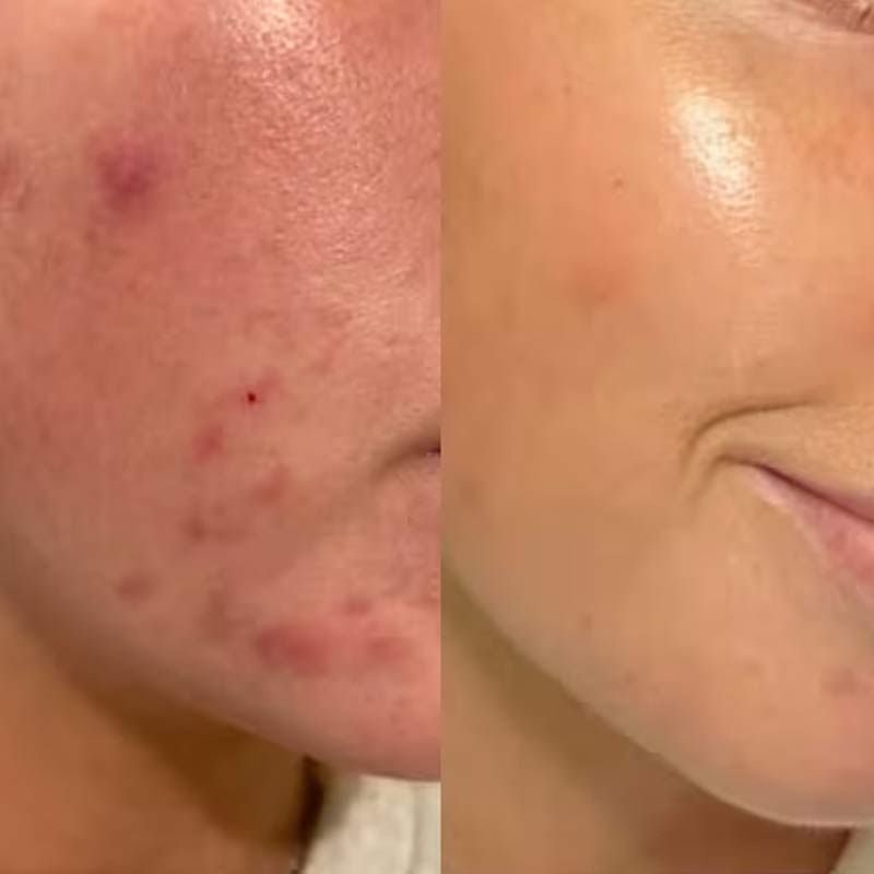 Skin Perfecting 2% BHA Exfoliating Toner Travel Size by Paula's Choice